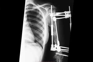 В Клиниках СамГМУ пациентке удлинили руку на 13 сантиметров