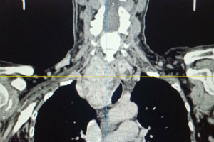 В Клиниках СамГМУ успешно прооперировали сложный случай токсического зоба у пациентки из Пензенской области