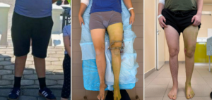  Деформация была асимметричная, необходимо было нарастить длину конечности.