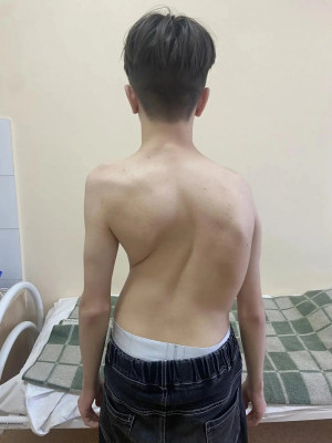 самарские травматологи провели 6-часовую операцию в условиях ракетной опасности